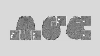 Researchers Identify Inflamed Brain Cells Likely Involved in MS Nerve Degeneration