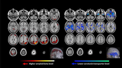 Amyloid Beta and Serotonin May Be Keys to Predicting Who Develops Late-Life Depression