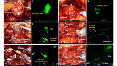 Novel Intraoperative Prostate Cancer Imaging Method Reveals Previously Undetectable Disease