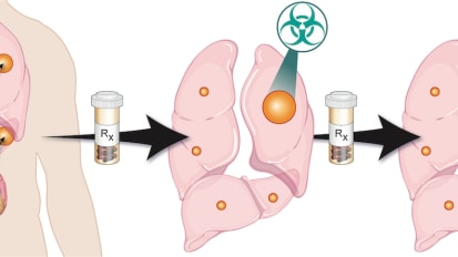 Clinical Trial Shows Stereotactic Radiation Extends Systemic Therapy and Slows Kidney Cancer Progression