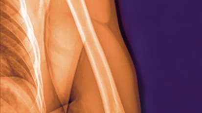 Musculoskeletal Oncology