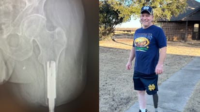 At UTSW, an innovative procedure offers new hope for amputees