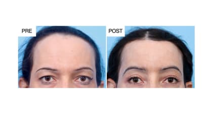 UCSF Surgeons Standardize Browlift and Hairline Surgery Using Photo Analysis