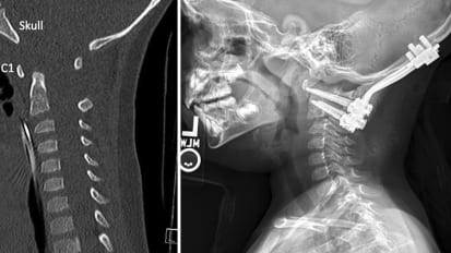 Lifesaving spinal fusion repairs toddler’s atlanto-occipital dislocation (AOD)