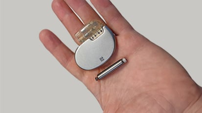 UC Davis doctor first in the world to implant a retrievable leadless pacemaker in a child