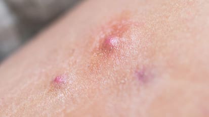 Are New Therapies on the Horizon for Painful Skin Condition?