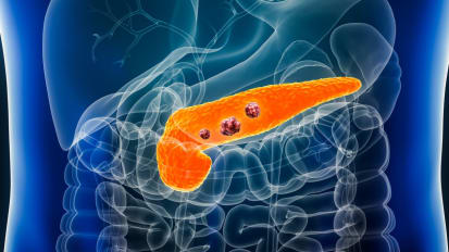 Pancreatic Cancer: Study Finds Most Early Staging Inaccurate