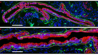 Penn Study Uncovers How Pancreatic Cells Reprogram Themselves to Limit the Immune Response in Patients at Risk for Type 1 Diabetes