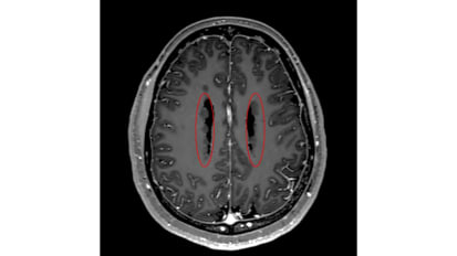 Innovative, Minimally Invasive Treatment for Drug-Resistant Epilepsy