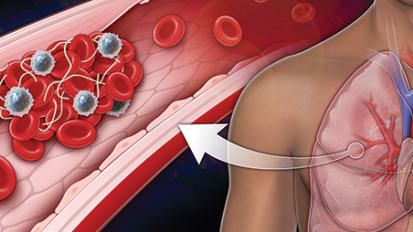 PERT Transforms<br> Pulmonary Embolism Care<br>and Practice