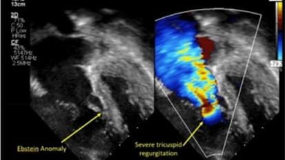 Cone Procedure to Treat Ebstein's Anomaly