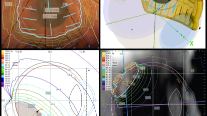 PRAME induces genomic instability in uveal melanoma