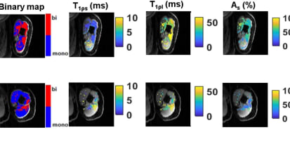 Johns Hopkins Researchers Develop and Use New Technology to Improve Rehab After Stroke