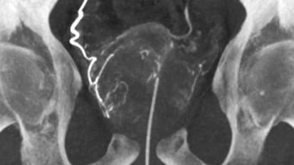 UCI Health Offers Prostatic Artery Embolization