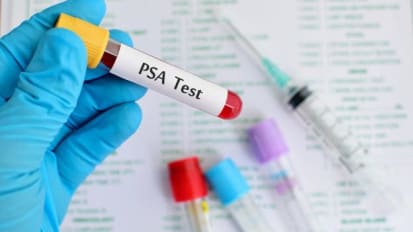 Personalizing Prostate Cancer Screening May Improve the Accuracy of Detection