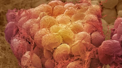 Quantity of Body Fat, Rather Than Location, May Be Key for Cardiovascular Diseases