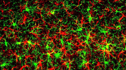 Scientists identify protein that heightens neurodegenerative disease