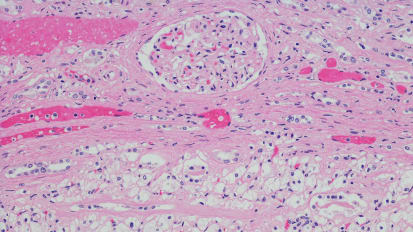 Renal Cell Carcinoma Research Sheds New Light on Advanced Disease