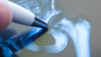 RESTORE Program Provides Special Care for Seniors with Fractures