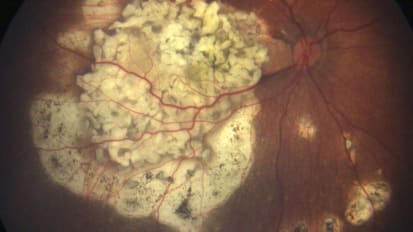 Researchers discover new molecular driver of retinoblastoma