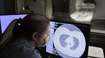 A Bold Approach to Early Lung Cancer Detection–and Action