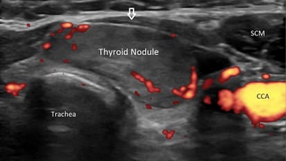 Radiofrequency Ablation Offers a Nonsurgical Treatment for Thyroid Nodules