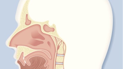 New Guidance on Using Biologics to Treat Chronic Rhinosinusitis with Nasal Polyps, Led by UCSF Clinician