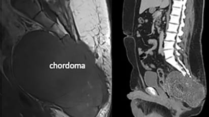 Precision En bloc Resection for Sacral Chordoma
