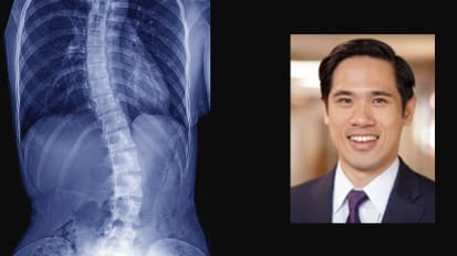 A New Modular Radiographic Classification of Adult Idiopathic Scoliosis as an Extension of the Lenke Classification of Adolescent Idiopathic Scoliosis