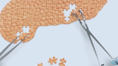 Pancreatic Cancer: Catching It Before It's Too Late