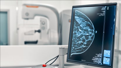 Therapy for Small, HER2-positive Breast Tumors Continues to Be Highly Effective After 10 Years, Study Finds