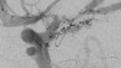 Paving a Path for Treating Pediatric Moyamoya