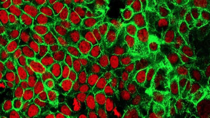 Anti-inflammatory Drug Celecoxib Could Reduce Risk of Colon Cancer Recurrence for a Subset of Patients