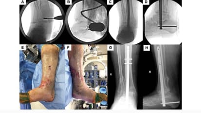 Surgeon: MIS improves outcomes for foot and ankle