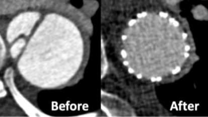 Landing Zones Optimization Using Transcatheter Electrosurgical Septotomy for Endovascular Repair of Postdissection Aortic Aneurysms