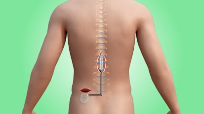 Zapping Back Pain: Spinal Cord Stimulation Changes Patient’s Life