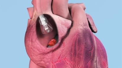 Sentara first in region to remove blood clots without open surgery