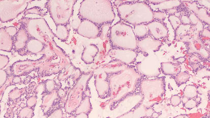 Characterizing Unique Underlying Molecular Features of Spinal Cord Gliomas