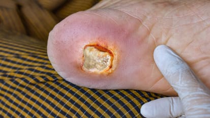 Novel JAMA Study on Diabetic Foot Ulcers: Best Practices for Treatment and Prevention