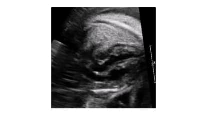 Decreasing Time Between Birth and BAS Improves Outcomes in Infants with d-TGA