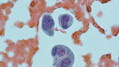 Study Shows That Immune System Holds Clues to Patients With High-Risk Smoldering Myeloma Likely to Benefit From Treatment