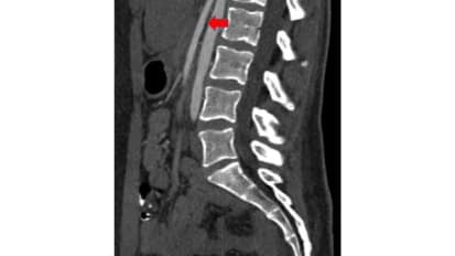 When an Eating Disorder Is Not an Eating Disorder