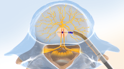 Breakthrough relief for chronic low back pain: The Intracept procedure