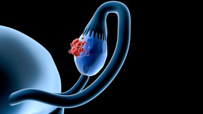 PARP Inhibitors Now Used for First- and Second-Line Maintenance of Ovarian Cancer