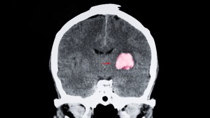 First in the Nation: Novel Stroke Treatment Shows Early Promising Results