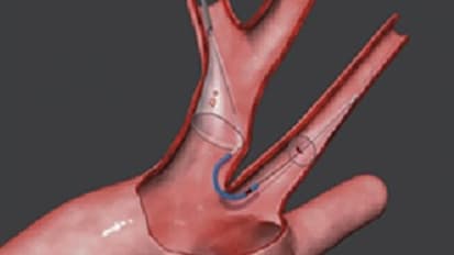 Penn Heart & Vascular: First to Offer Embolic Protection Device during TAVR for Stroke Prevention in Philadelphia
