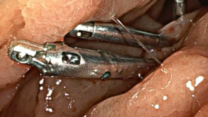 Don’t Assume Hemorrhoids: how a rectosigmoid lesion harboring invasive carcinoma was successfully treated endoscopically