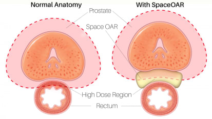 SpaceOAR Hydrogel Reduces Side Effects of Prostate Cancer Radiation Therapy