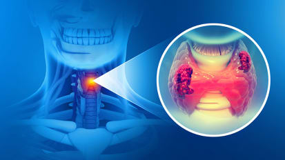 Thyroid Cancer: What Are the Latest Advances in Treatment?