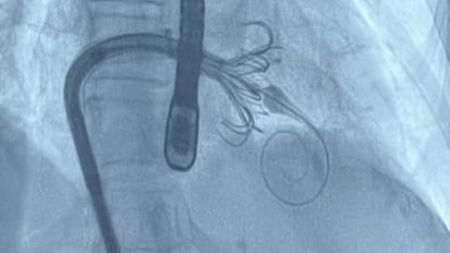 Novel Tricuspid Valve Procedure Improves Patients' Quality of Life and Health Status